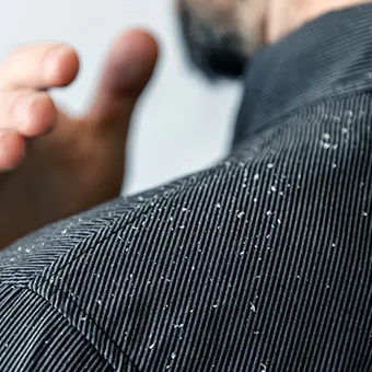 Close-up of white flakes on the shoulder of a man’s dark striped shirt