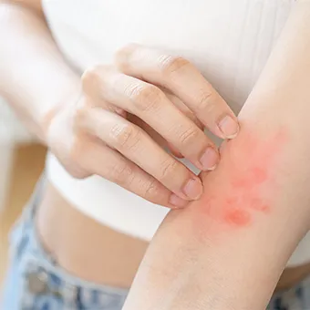 มือกำลังเกาผื่นแดงที่ด้านในของแขน