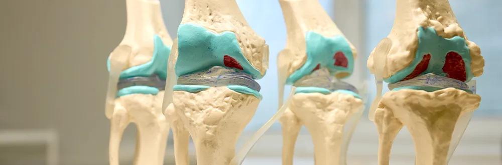 Four models of the knee joint in a row, with the cartilage in pale blue and patches of red on the bone